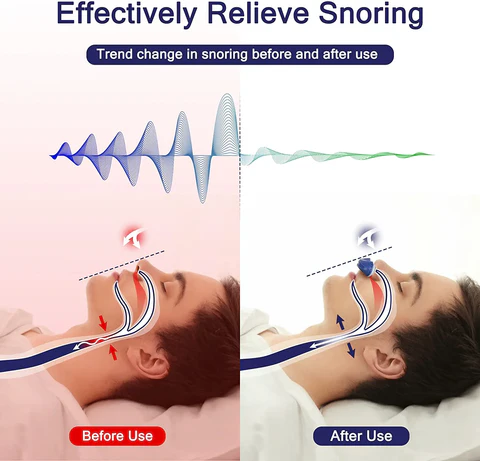 Dispositif Micro CPAP Portable | Sommeil Réparateur en Voyage