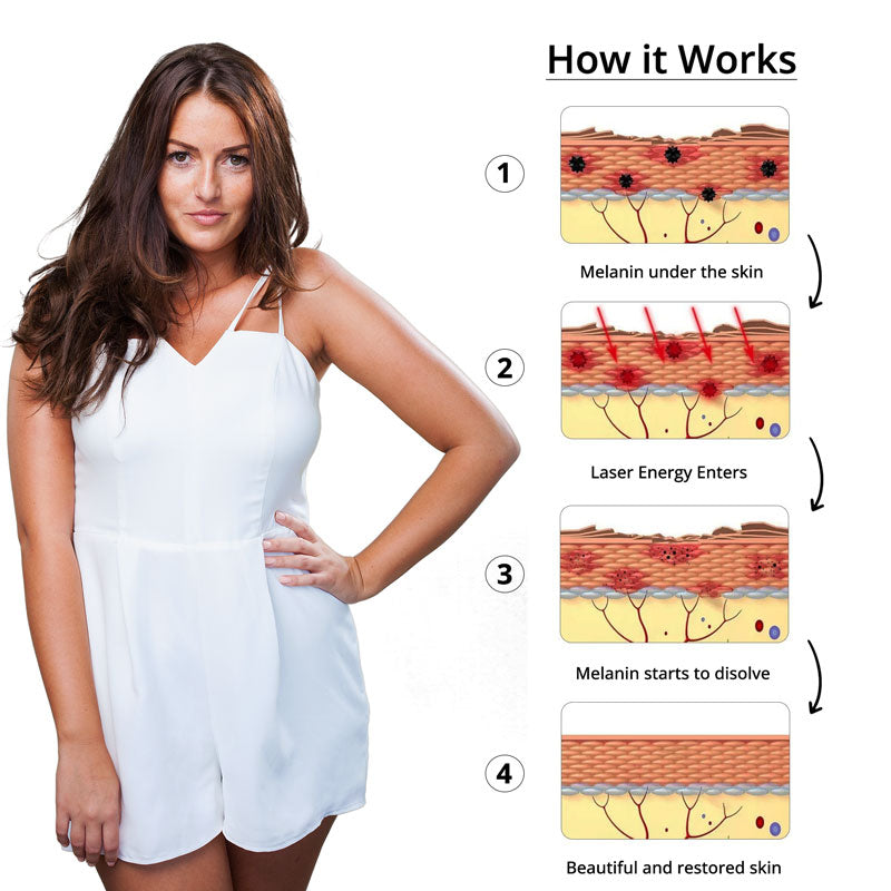 Stylo Laser pour Retrait de Tatouage | Technologie Picoseconde et Dommages Minimaux