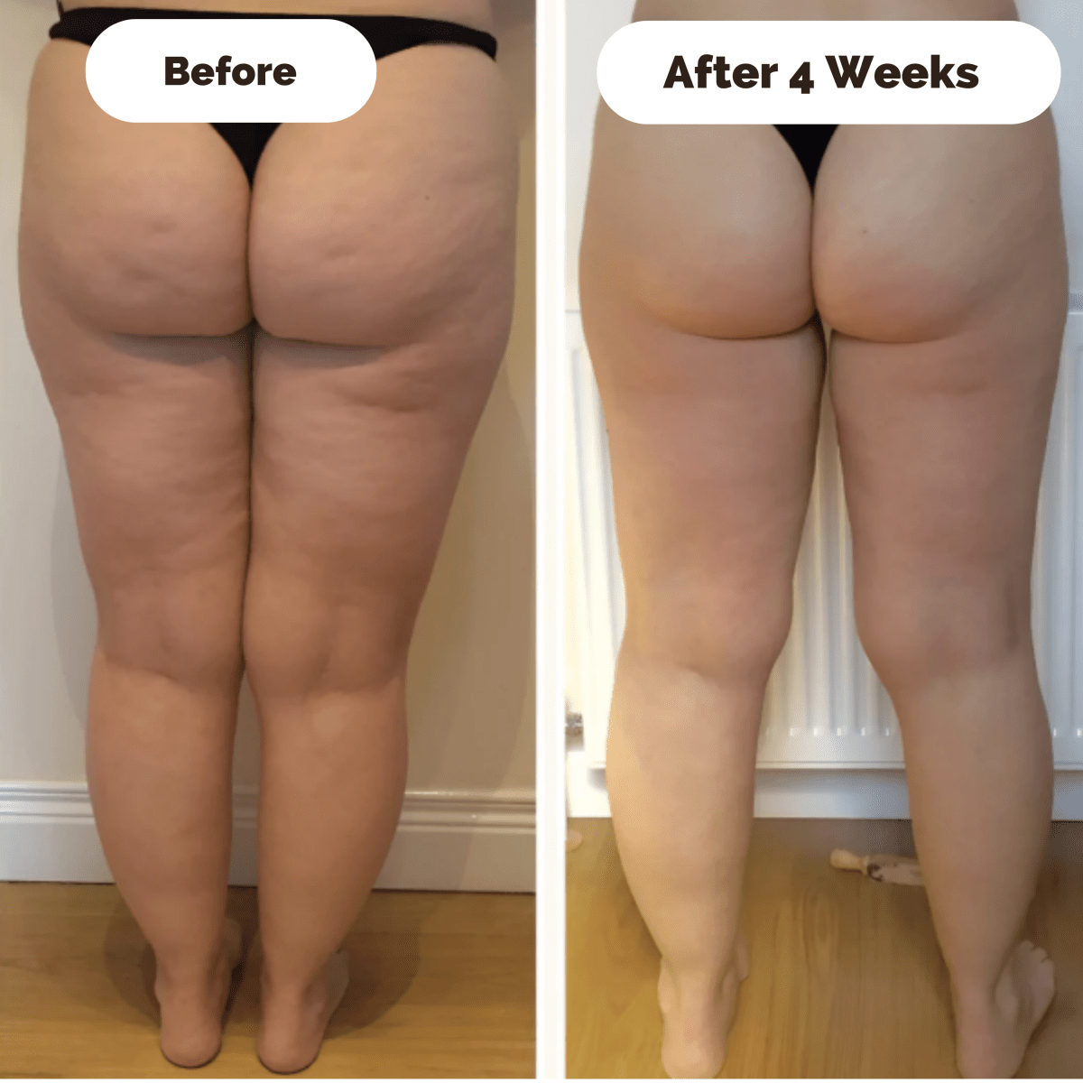 Appareil de Massage Anti-Cellulite | Raffermissant et Lissant pour la Peau