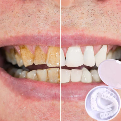 Facettes Dentaires Réutilisables | Sourire Parfait et Confort Optimal